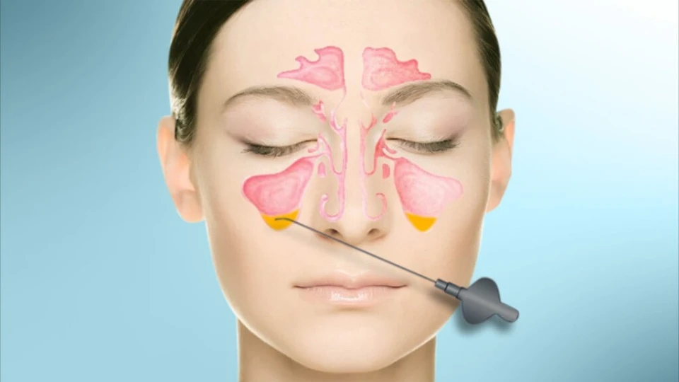 лечение синусита