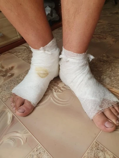 Під час зйомок пожеж Олексій отримав опіки ніг