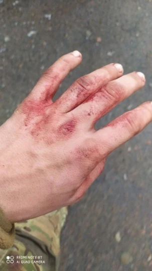 кров на руках Олексія, військового з Луганщини