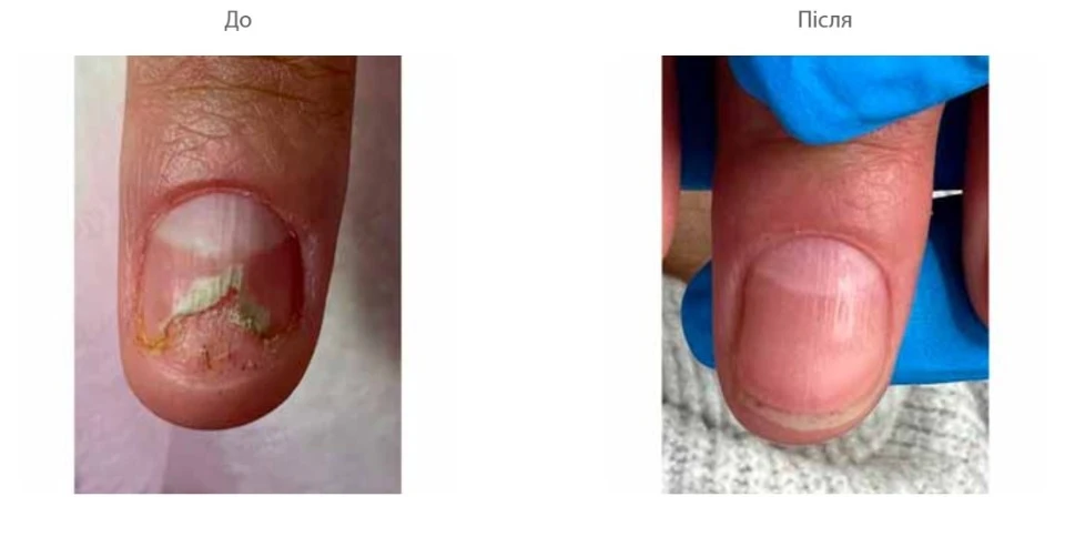 лечение грибка ногтей